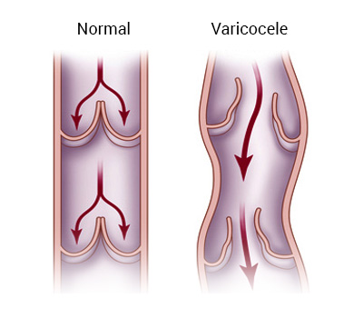 Reflux (backflow) to the vein