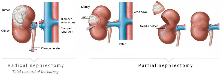 Radical nephrectomy  & Partial nephrectomy 