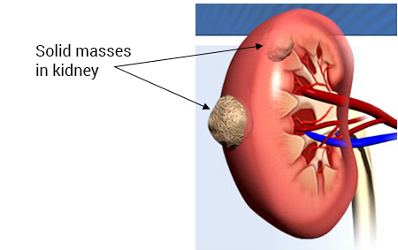 Solid masses in kidney