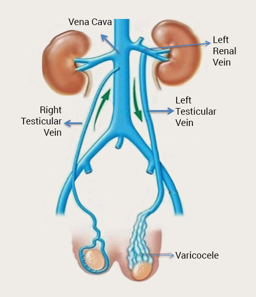 Anatomical differences between the right and left testicular veins: